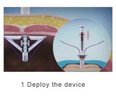 Disposable Trocar Port Site Closure & Fascial Suturing Device - Image 2