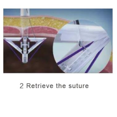Disposable Trocar Port Site Closure & Fascial Suturing Device - Image 3