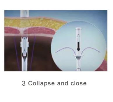 Disposable Trocar Port Site Closure & Fascial Suturing Device - Image 4