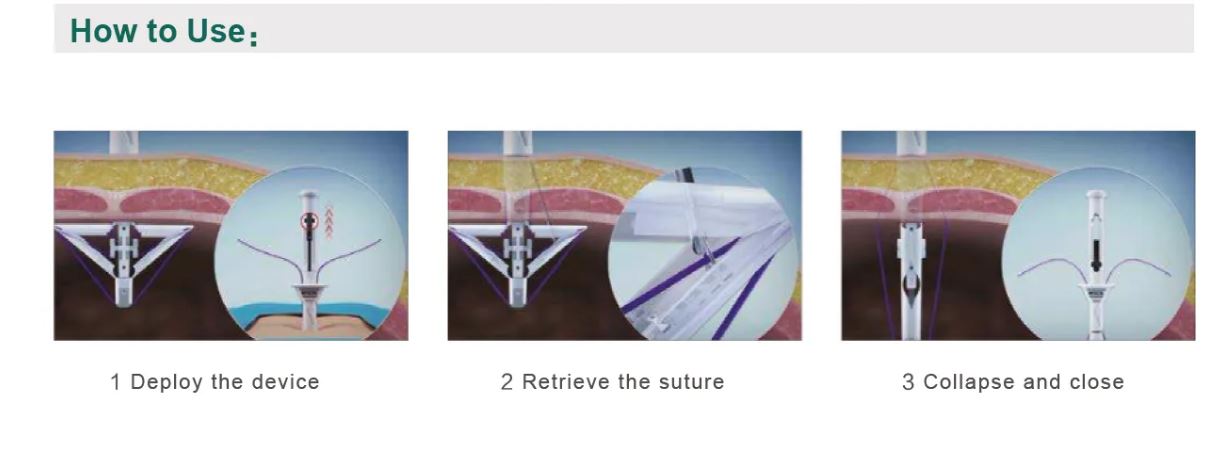 Disposable Trocar Port Site Closure & Fascial Suturing Device - Image 5