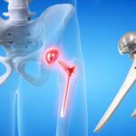 Spinal & Hip Prostheses