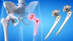 Spinal & Hip Prostheses