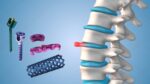 Spinal & Hip Prostheses - Image 4