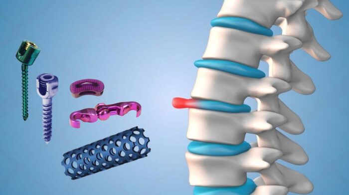 Spinal & Hip Prostheses - Image 4