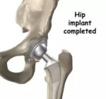 Spinal & Hip Prostheses - Image 2