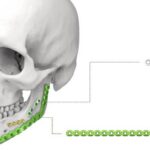 Mandibular Reconstruction Plates