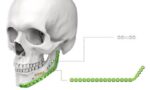 Mandibular Reconstruction Plates