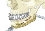 Mandibular Reconstruction Plates - Image 3