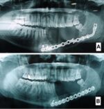 Mandibular Reconstruction Plates - Image 2