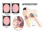 ENT - Myringotomy Kit - grommet kit - Image 3