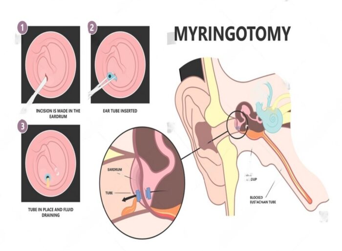 ENT - Myringotomy Kit - grommet kit - Image 3