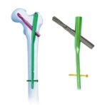 Intramedullary Nails (Tibial & Femoral) - Image 3