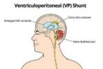 VP shunt - Image 3