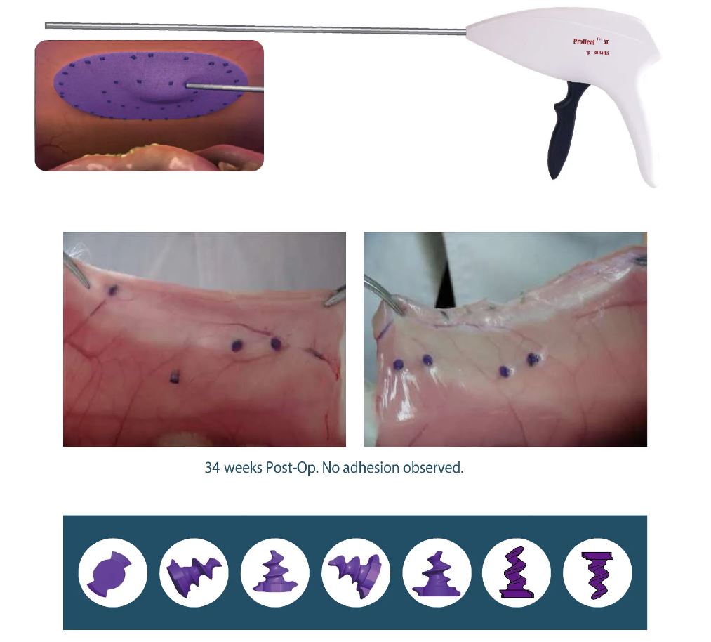 ProHeal absorbable laparoscopic mesh fixation device 5mm tacker for hernia repair surgery